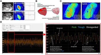Monitoring coronary blood flow by laser speckle contrast imaging after myocardial ischaemia reperfusion injury in adult and aged mice